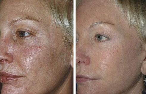 frakčná laserová rejuvenizácia pred a po fotkách