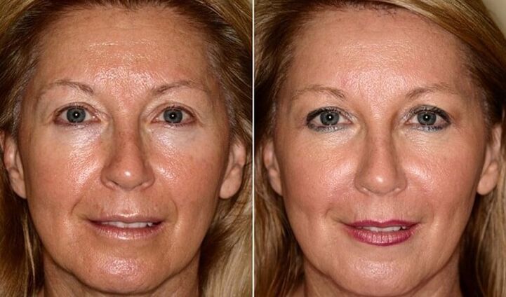 pred a po omladení pokožky tváre doma