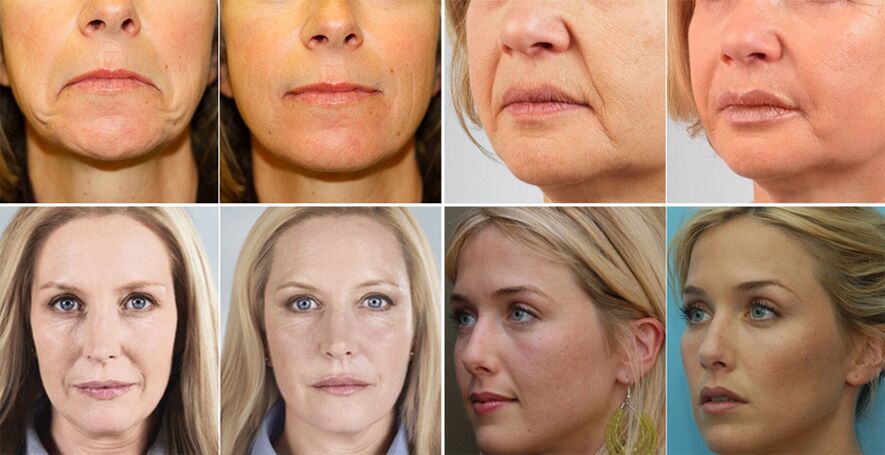 fotografie žien pred a po omladení pokožky tváre